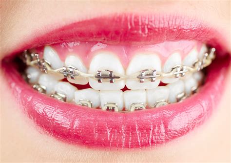 metal brackets orthodontics|best metal braces for teeth.